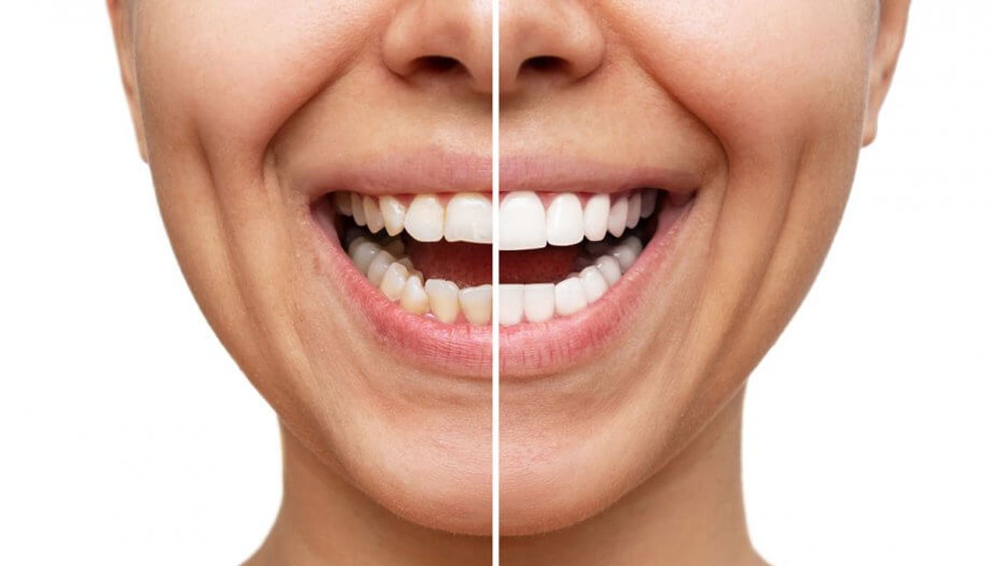 Faccette dentali per Catanzaro e provincia presso Dental Wellness