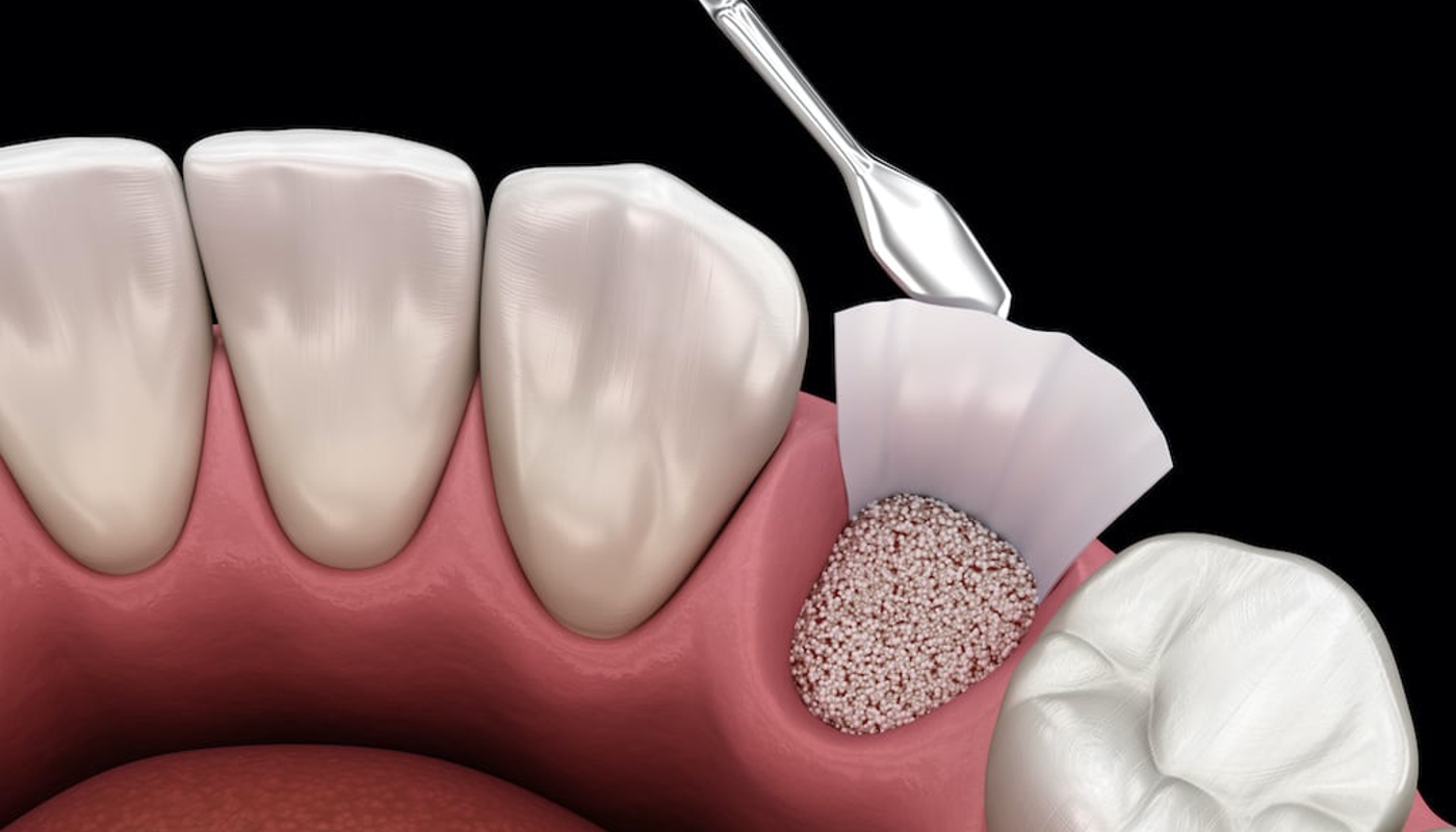 Rigenerazione ossea dentale