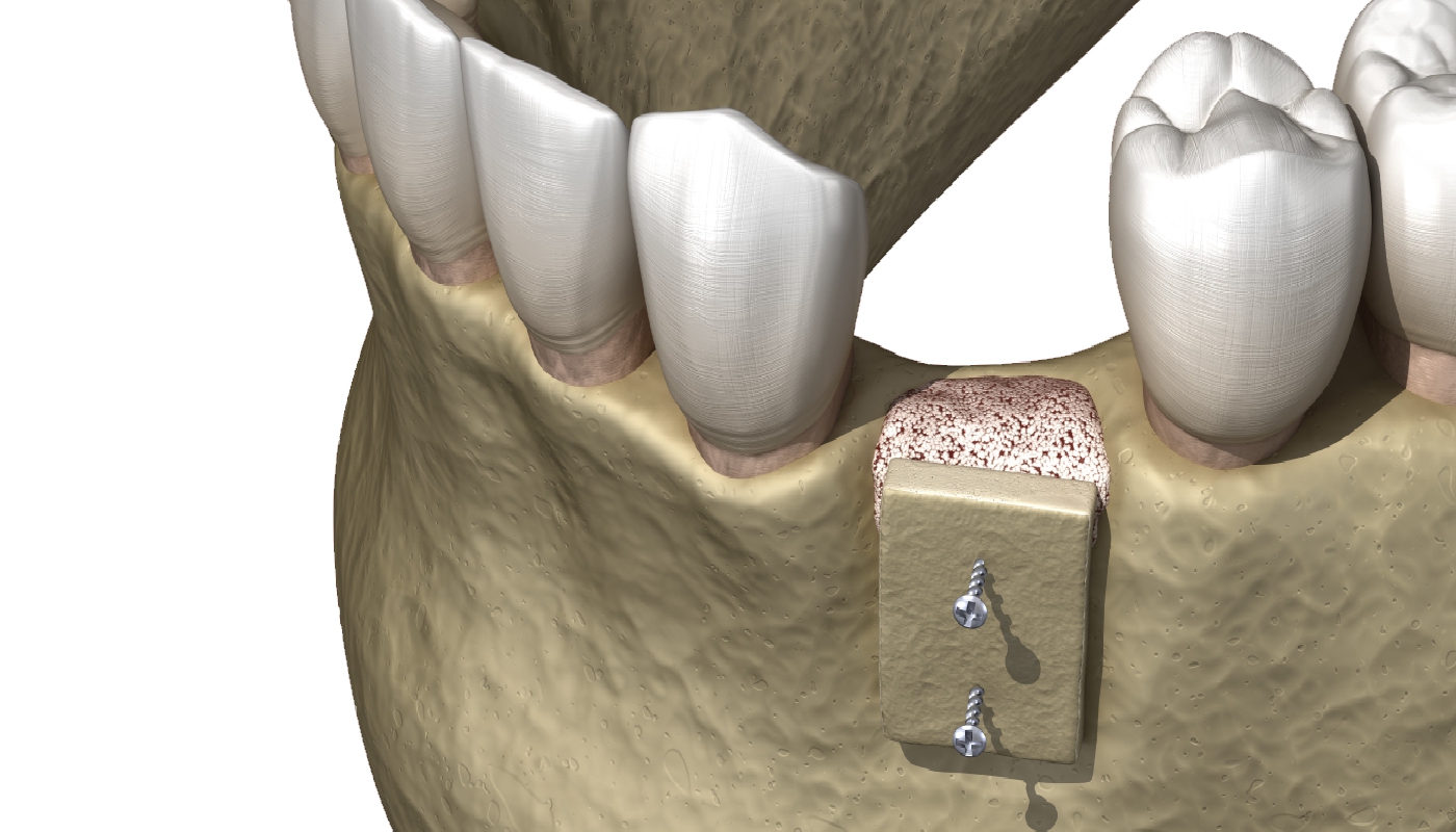 Trapianto dentale naturale