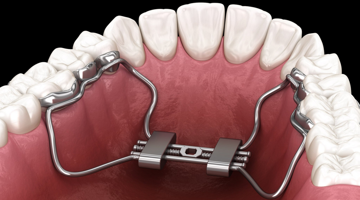 Espansione del palato per Catanzaro e provincia presso Dental Wellness