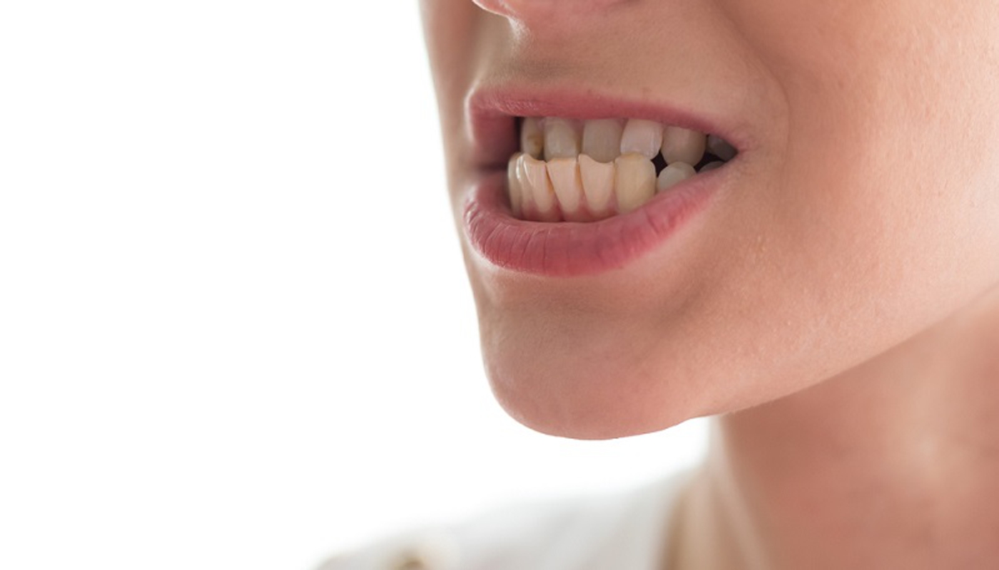 Malocclusione dentale per pazienti di Catanzaro e provincia