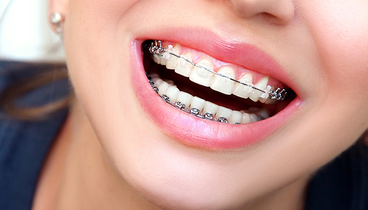 Ortodonzia intercettiva per bambini di Catanzaro e provincia