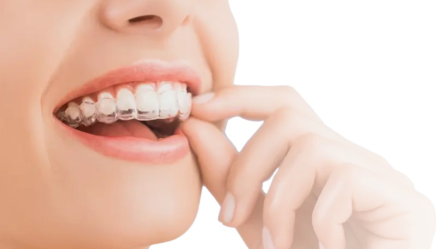 Ortodonzia invisibile per pazienti di Catanzaro e provincia